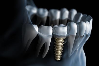 Dental Implants - Periodontist in Parsippany, NJ