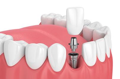 Sunrise Dental Spokane Valley - General dentist in Spokane, WA