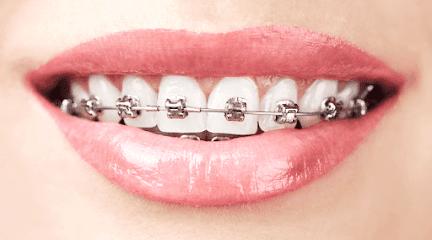Braces Las Vegas - Orthodontist in Las Vegas, NV