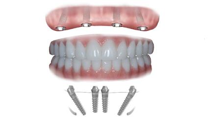 Digital dental implants - Periodontist in Long Beach, CA