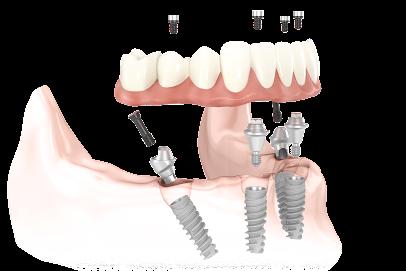 Kansas City Dental Implant Center - Periodontist in Leawood, KS