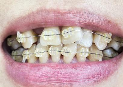 On Four Dental Implants - Periodontist in Patchogue, NY