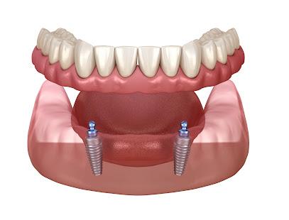 Memphis Dental Implants Center - Oral surgeon in Southaven, MS