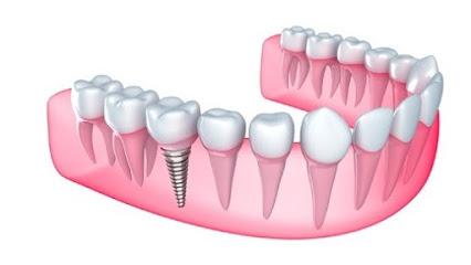 Dr Naser Sharifi Implant Dentistry - General dentist in Glen Oaks, NY
