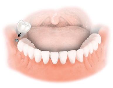 Dental Implant Solutions Plano, IL - Cosmetic dentist, General dentist in Plano, IL