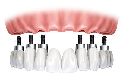 Full Mouth Dental Implants - Periodontist in Budd Lake, NJ