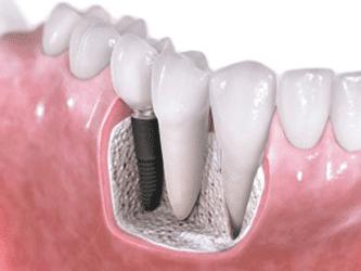Dental Implant Centers of Huntington Beach - Periodontist in Westminster, CA
