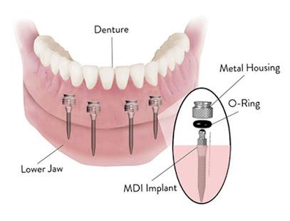 Dental Implant Solutions Decatur, GA - Cosmetic dentist in Decatur, GA