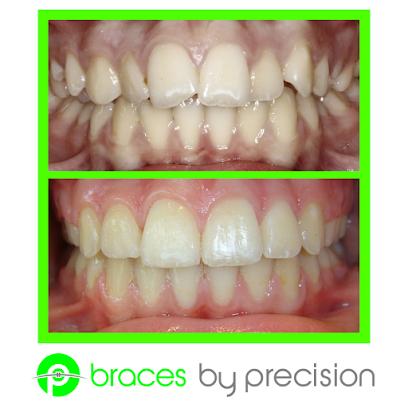 Precision Orthodontics - Orthodontist in Auburn, CA